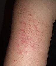 Keratosis Pilaris | Allergy Symptom